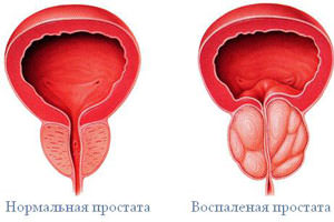 простата